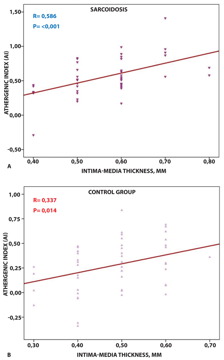 Atherogenic Indices Can Predict Atherosclerosis in Patients with Sarcoidosis.