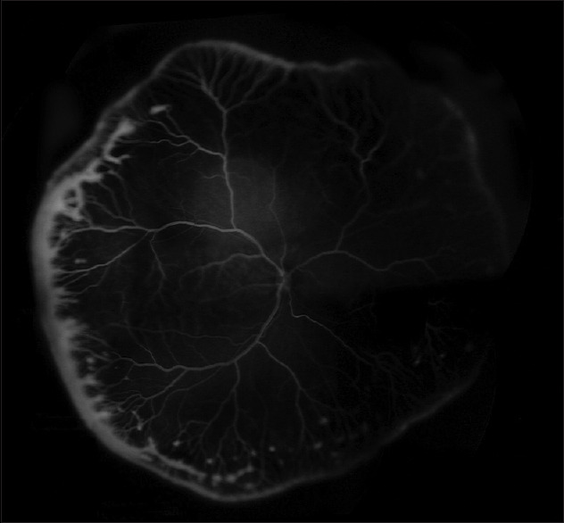 Multimodal Imaging, Tele-Education, and Telemedicine in Retinopathy of Prematurity.