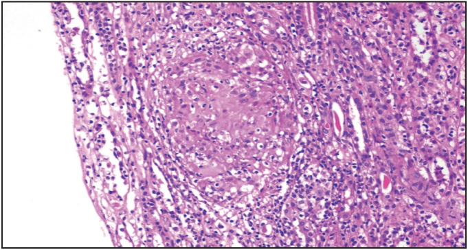 Causes of Granulomatous Inflammation in Native and Allograft Kidneys: Case Series from A Single Center and A Review of the Literature.