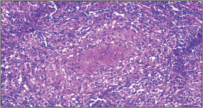 Causes of Granulomatous Inflammation in Native and Allograft Kidneys: Case Series from A Single Center and A Review of the Literature.