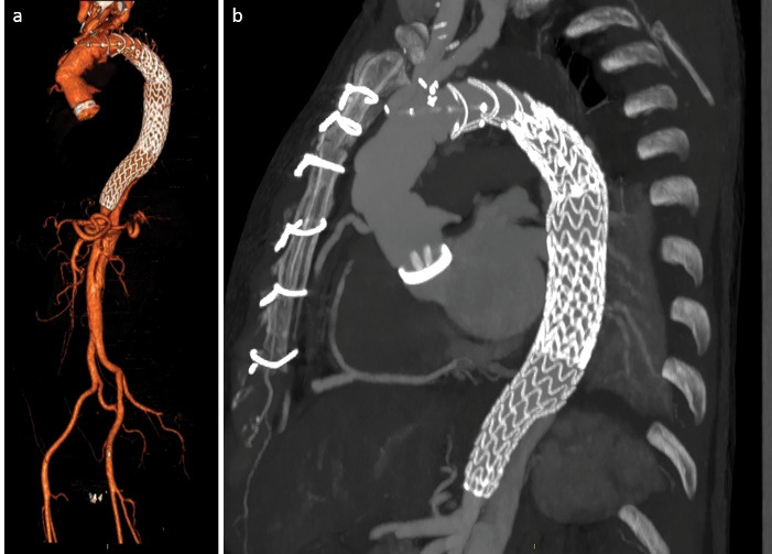 Total endovascular repair of a malpositioneted frozen elephant trunk with Thoraflex hybrid prosthesis: A case report.