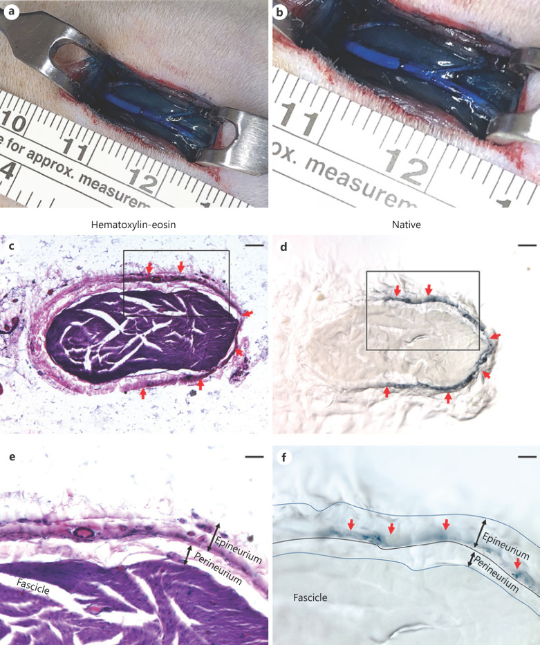 Epineural Methylene Blue Injection May Aid Localization of Digital Nerves in Dupuytren's Surgery.