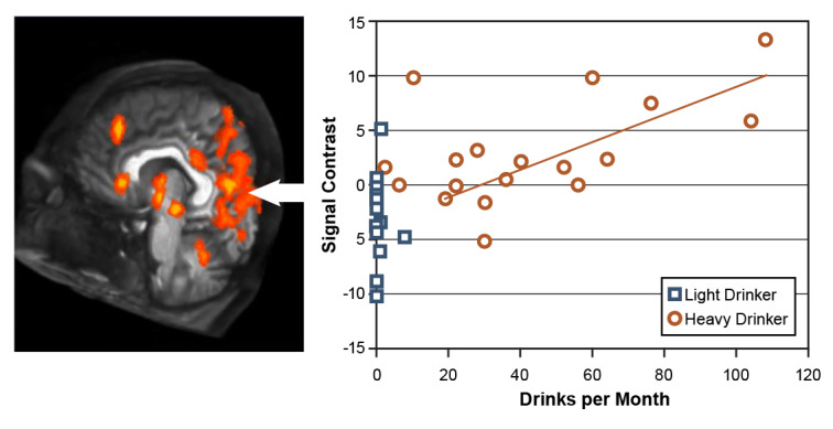 Alcohol and the Adolescent Brain: What We've Learned and Where the Data Are Taking Us.