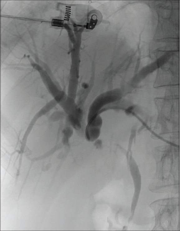 Percutaneous Y-shape reconstructive biliary stenting in Klatskin cholangiocarcinoma through a single left-sided entry.