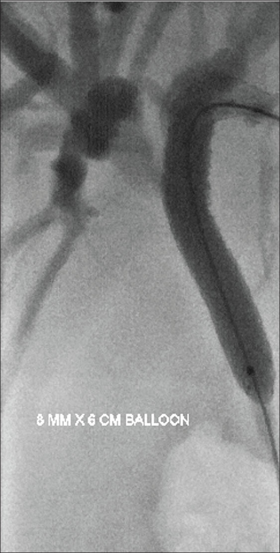 Percutaneous Y-shape reconstructive biliary stenting in Klatskin cholangiocarcinoma through a single left-sided entry.