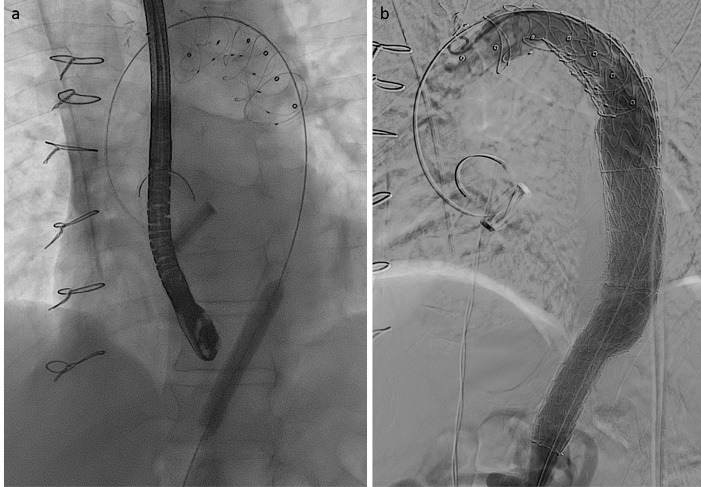 Total endovascular repair of a malpositioneted frozen elephant trunk with Thoraflex hybrid prosthesis: A case report.