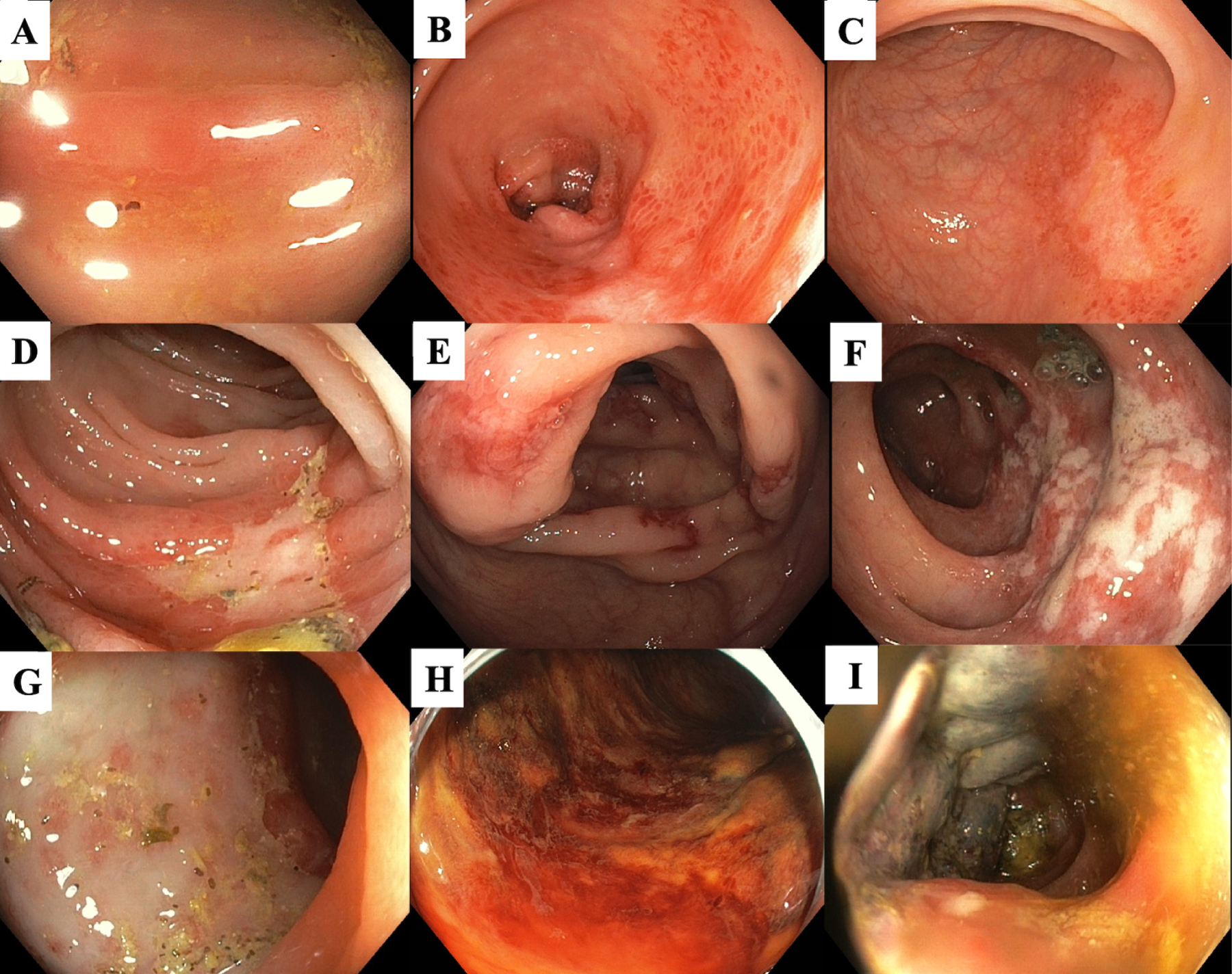 Ischemic colitis as a cause of severe hematochezia: A mini review.