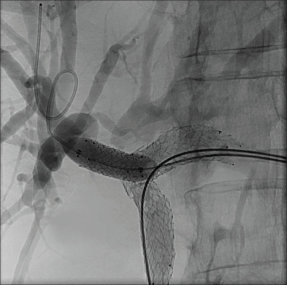 Percutaneous Y-shape reconstructive biliary stenting in Klatskin cholangiocarcinoma through a single left-sided entry.