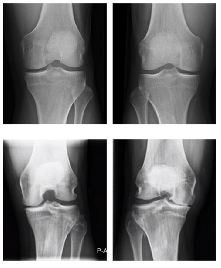 Osteoarthritic changes in the knees of recently retired male professional footballers: a pilot study.