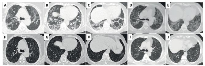 Clarithromycin in Post COVID-19 Organizing pneumonia.