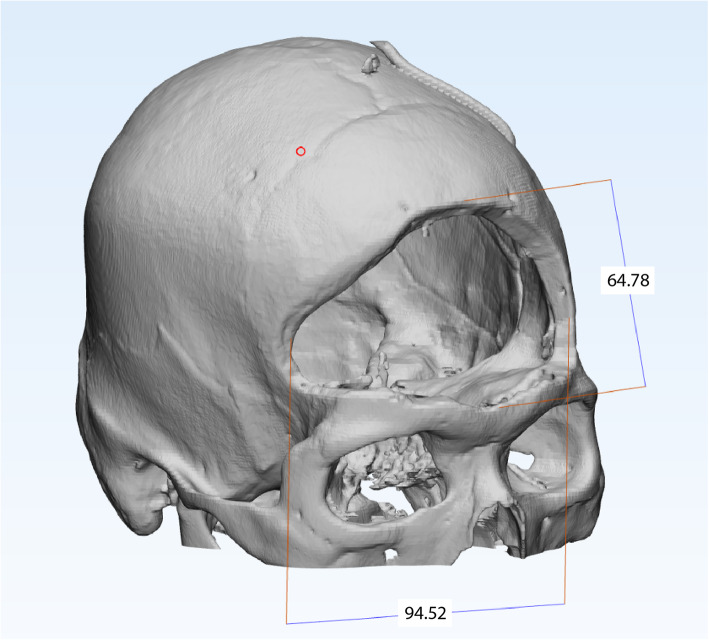 Patient-specific 3D-printed helmet for post-craniectomy defect - a case report.