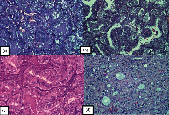 Clinicopathological Profile of Thyroid Carcinoma in Young Patients: An Indonesian Single-Center Study.