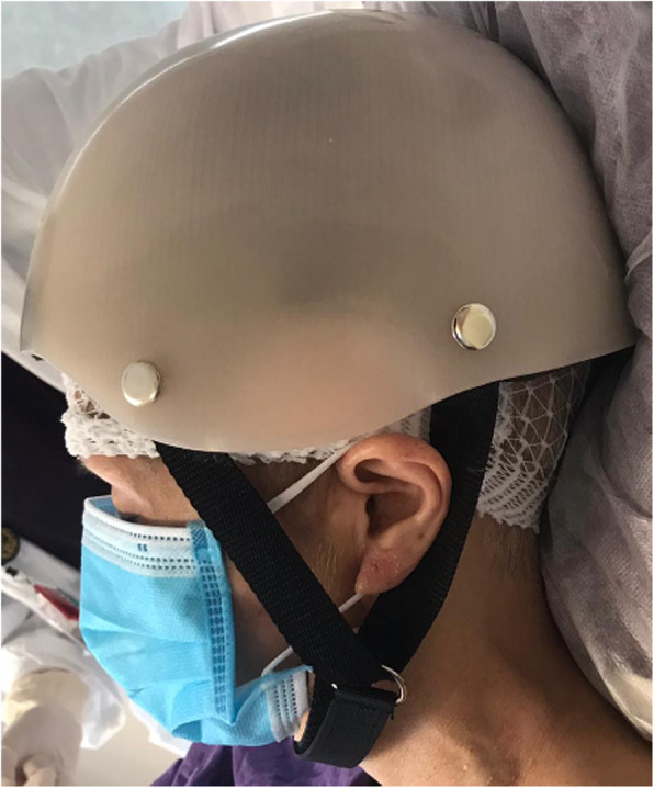 Patient-specific 3D-printed helmet for post-craniectomy defect - a case report.