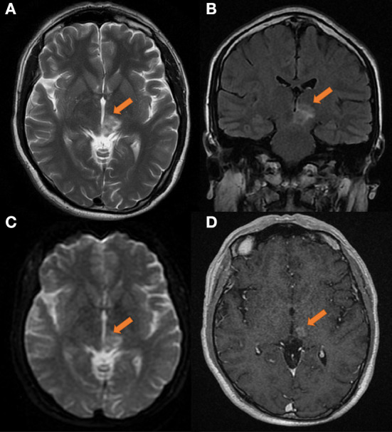 Transient partial regression of intracranial germ cell tumor in adult thalamus: A case report.