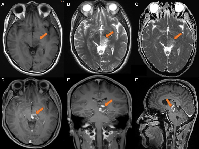 Transient partial regression of intracranial germ cell tumor in adult thalamus: A case report.