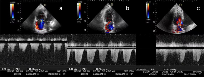 Pilot study on the value of echocardiography combined with lung ultrasound to evaluate COVID-19 pneumonia.