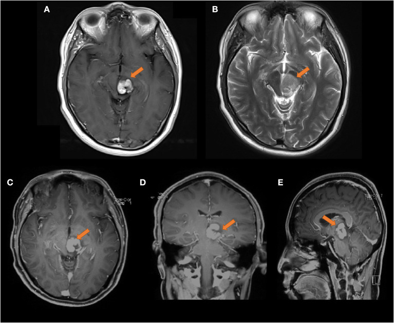 Transient partial regression of intracranial germ cell tumor in adult thalamus: A case report.