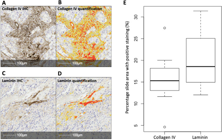 Magnetization transfer imaging of ovarian cancer: initial experiences of correlation with tissue cellularity and changes following neoadjuvant chemotherapy.