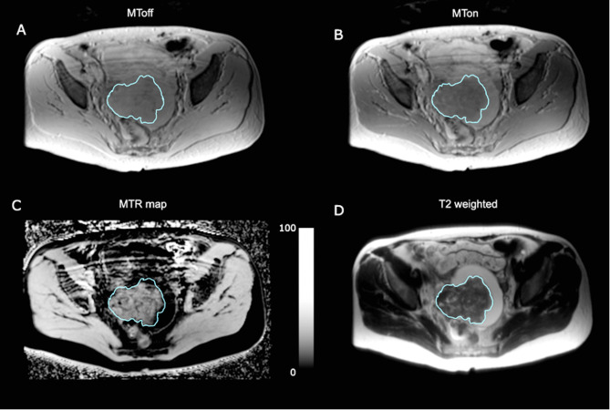 Magnetization transfer imaging of ovarian cancer: initial experiences of correlation with tissue cellularity and changes following neoadjuvant chemotherapy.