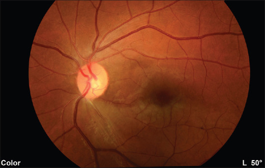 Branch Retinal Artery Occlusion Following Cocaine Inhalation: Case Report and Review of the Literature.