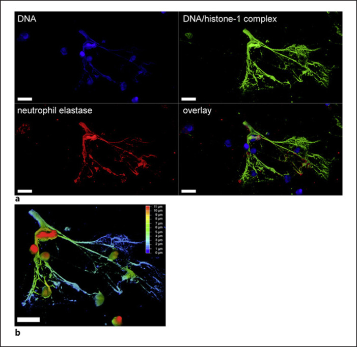 Impaired Degradation of Neutrophil Extracellular Traps: A Possible Severity Factor of Elderly Male COVID-19 Patients.