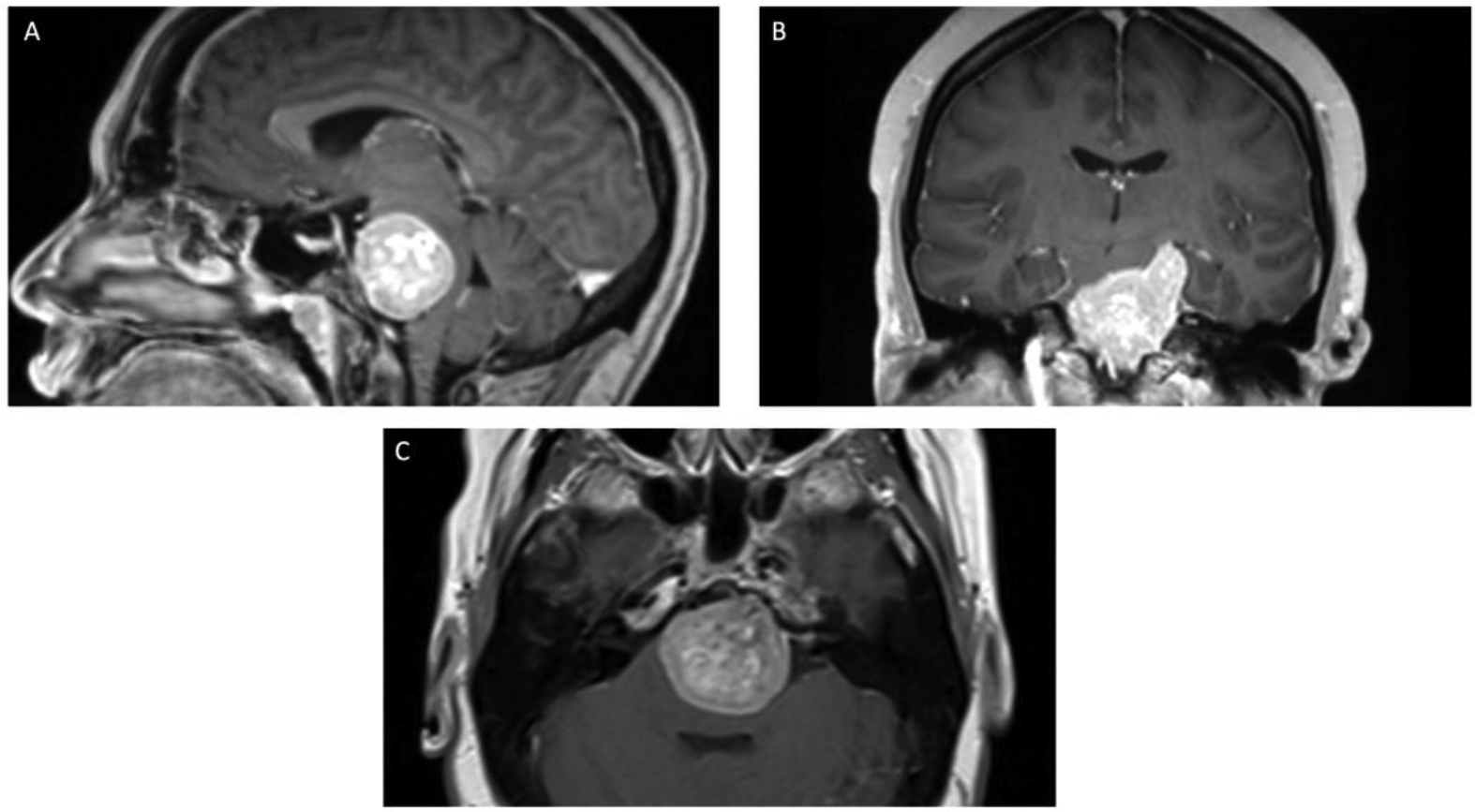 Clival Paraganglioma, Case Report and Literature Review.