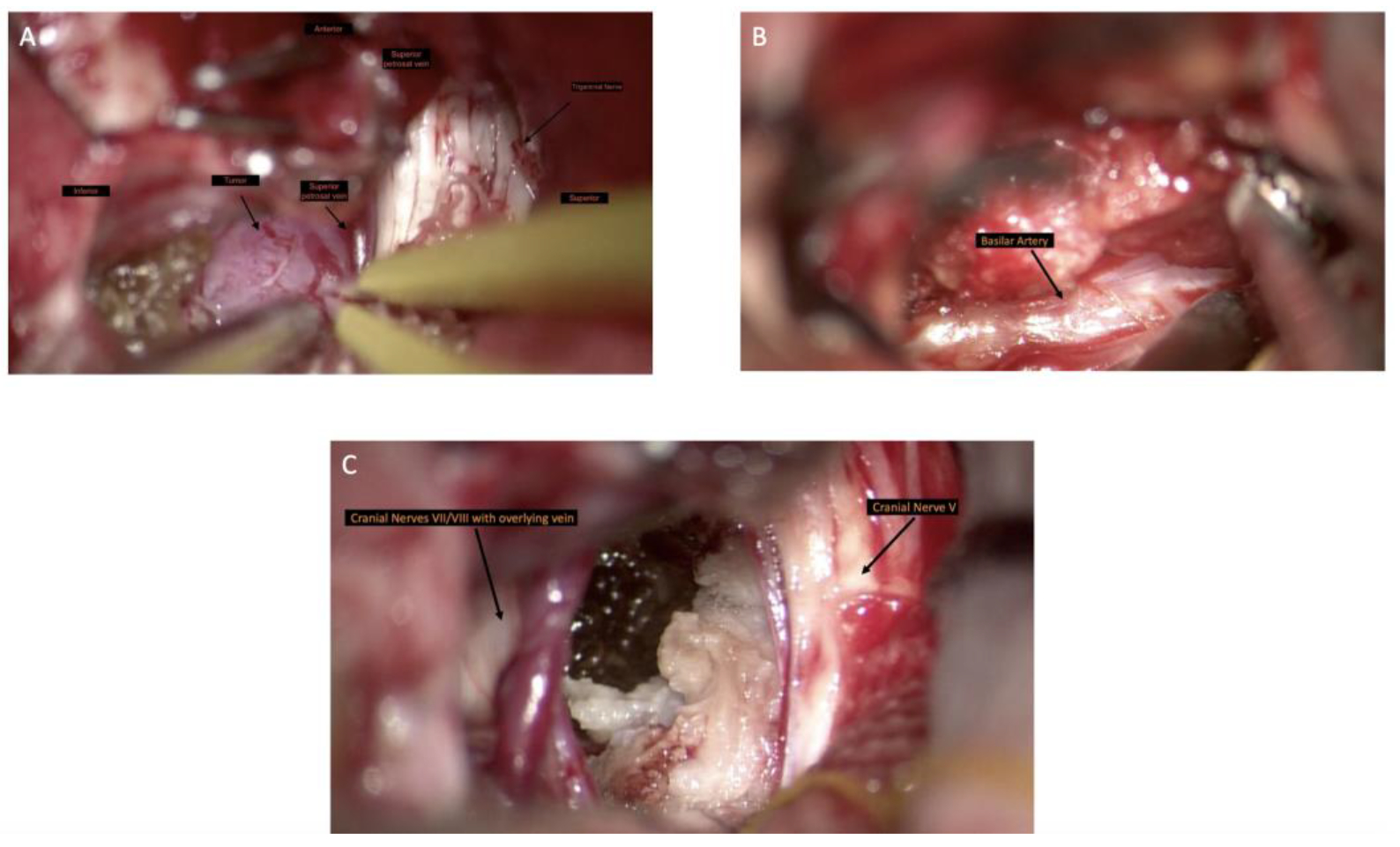 Clival Paraganglioma, Case Report and Literature Review.