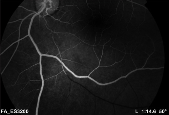 Branch Retinal Artery Occlusion Following Cocaine Inhalation: Case Report and Review of the Literature.