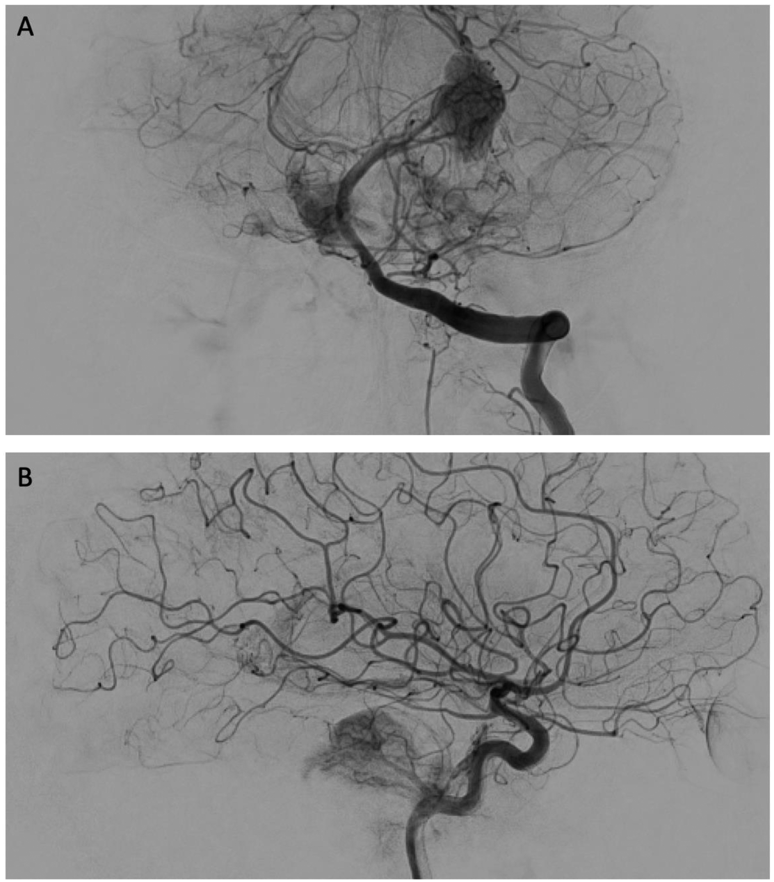 Clival Paraganglioma, Case Report and Literature Review.