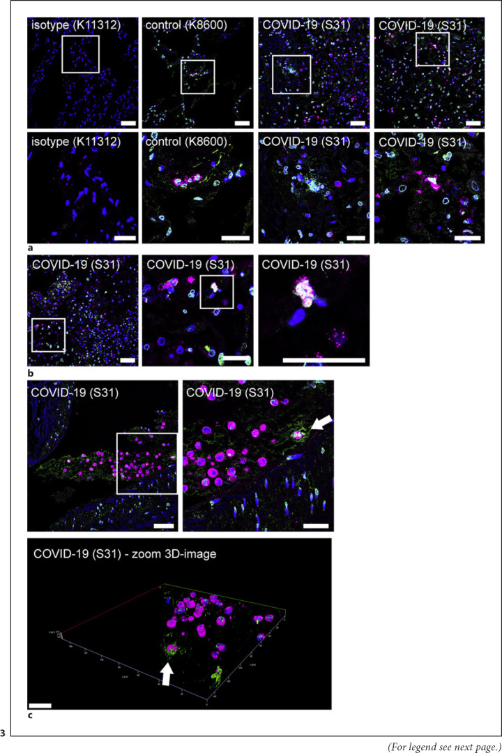 Impaired Degradation of Neutrophil Extracellular Traps: A Possible Severity Factor of Elderly Male COVID-19 Patients.