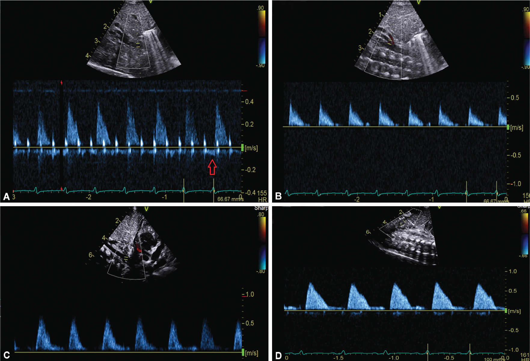 Necrotizing Enterocolitis Associated with Congenital Heart Disease-A Review Article.