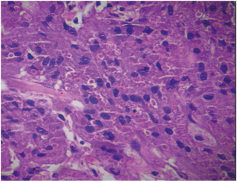 An Unusual Nodular Tumour of the Penile Shaft with Clinicopathologic and Immunohistochemical Correlation.