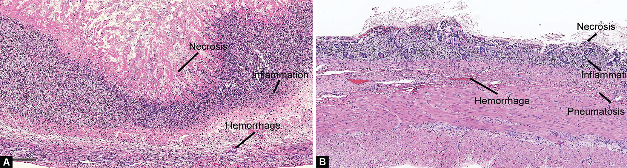 Necrotizing Enterocolitis Associated with Congenital Heart Disease-A Review Article.