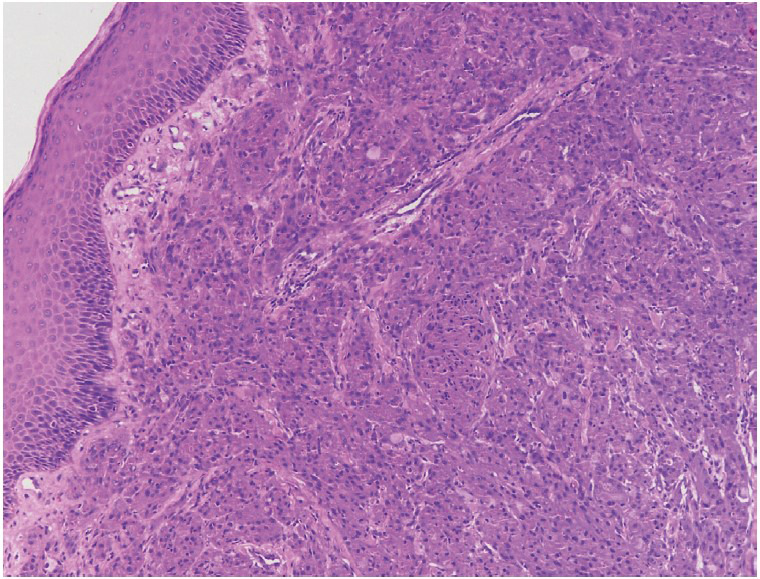 An Unusual Nodular Tumour of the Penile Shaft with Clinicopathologic and Immunohistochemical Correlation.