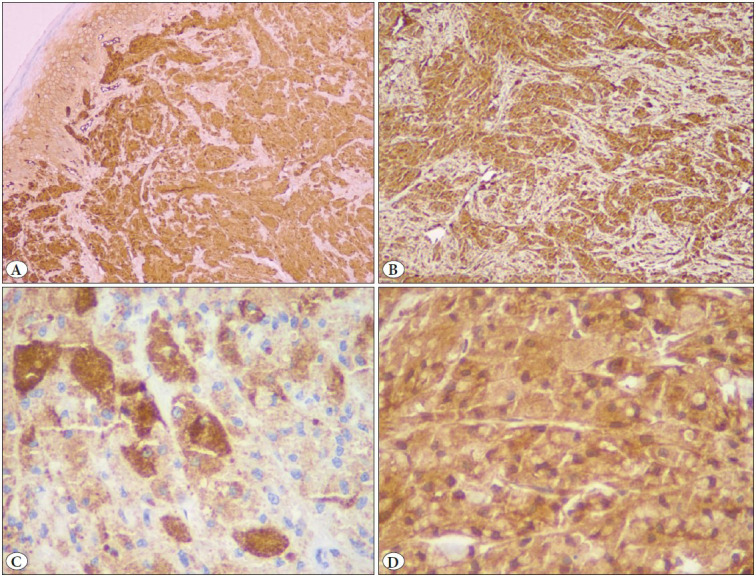 An Unusual Nodular Tumour of the Penile Shaft with Clinicopathologic and Immunohistochemical Correlation.