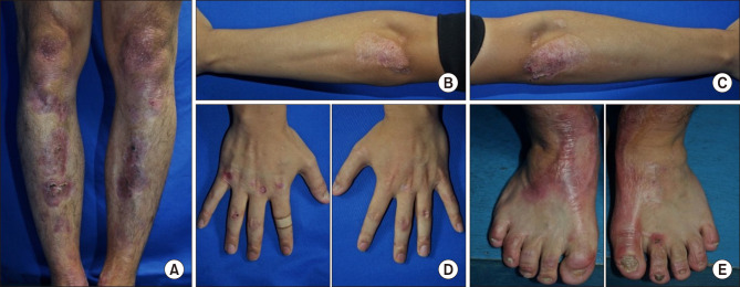 Dominant Dystrophic Epidermolysis Bullosa with a Mutation in <i>COL7A1</i> Confirmed by Diagnostic Exome Sequencing.