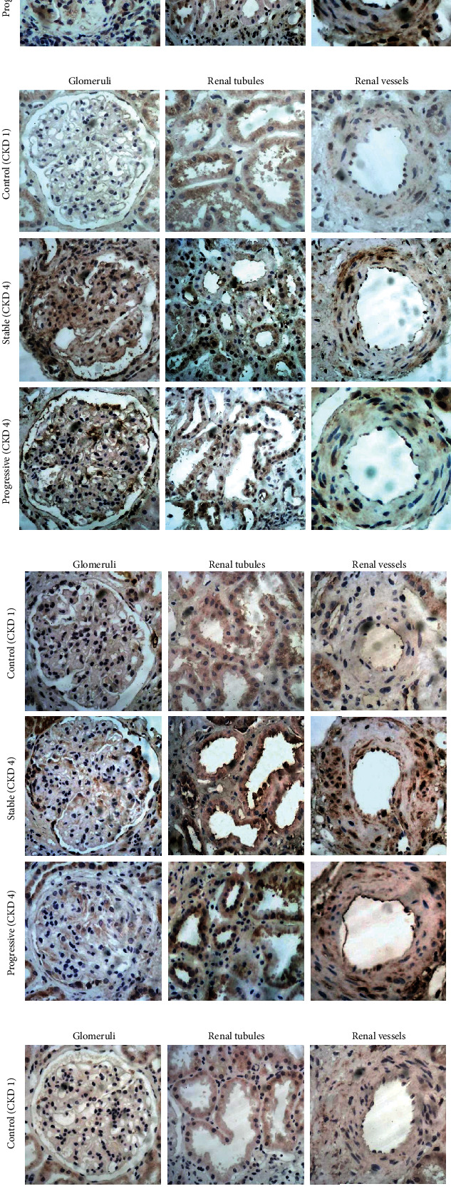 IgA Nephropathy with Macroproteinuria and a GFR of 20-30 ml/min/1.73 m<sup>2</sup> May Still Benefit from RAS Inhibition.