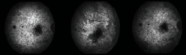 A Case Report of Purtscher-Like Retinopathy Secondary to <i>Pneumocystis jirovecii</i> Pneumonia in an Immunocompromised Patient.