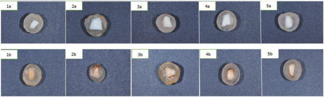 Effect of microabrasion on the staining susceptibility of enamel: An in vitro study.