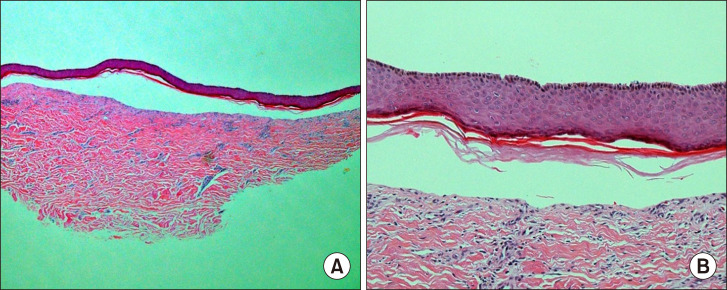 Dominant Dystrophic Epidermolysis Bullosa with a Mutation in <i>COL7A1</i> Confirmed by Diagnostic Exome Sequencing.