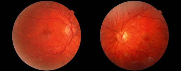 A Case Report of Purtscher-Like Retinopathy Secondary to <i>Pneumocystis jirovecii</i> Pneumonia in an Immunocompromised Patient.