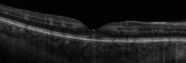 A Case Report of Purtscher-Like Retinopathy Secondary to <i>Pneumocystis jirovecii</i> Pneumonia in an Immunocompromised Patient.