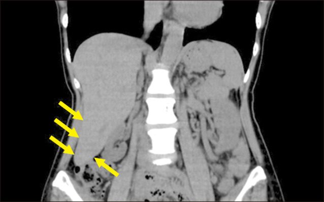 Riedel's Lobe of the Liver.