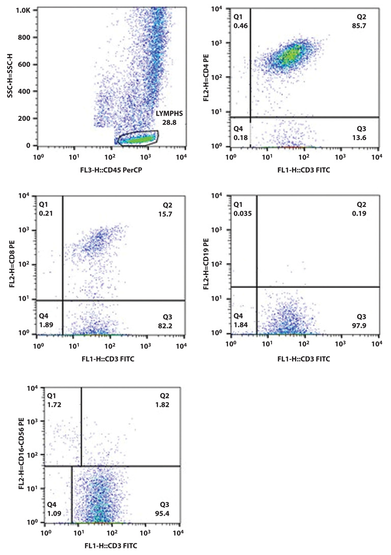 BALF and BLOOD NK- cells in different stages of pulmonary sarcoidosis.