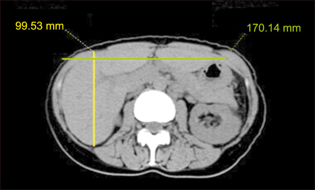 Riedel's Lobe of the Liver.