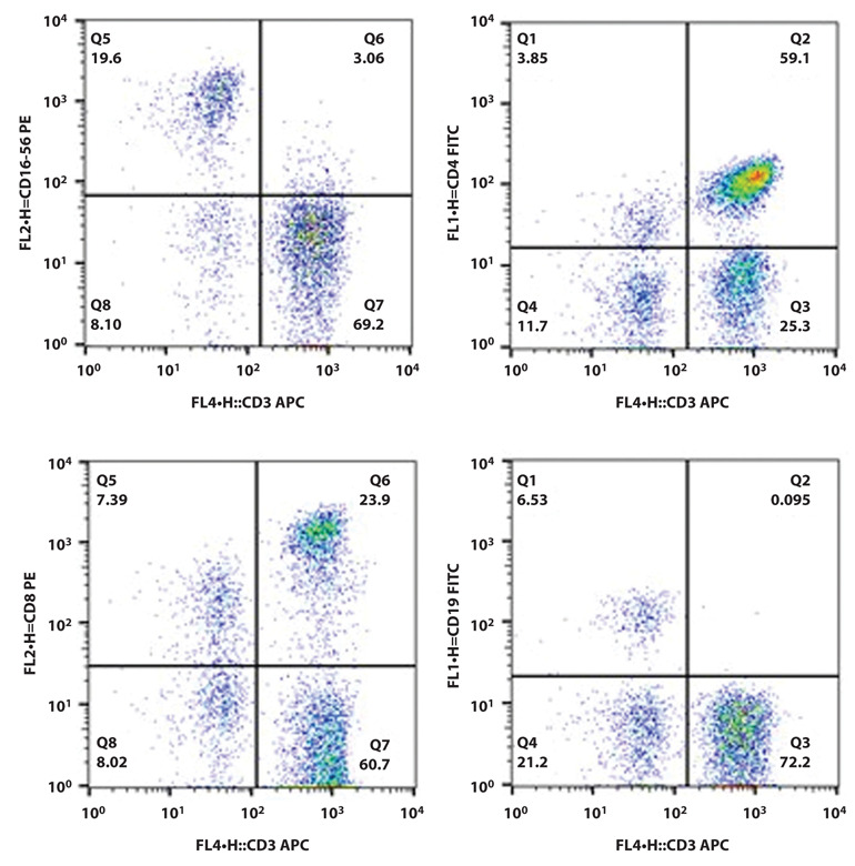 BALF and BLOOD NK- cells in different stages of pulmonary sarcoidosis.