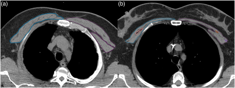 30 s sit-to-stand power is positively associated with chest muscle thickness in COVID-19 survivors.