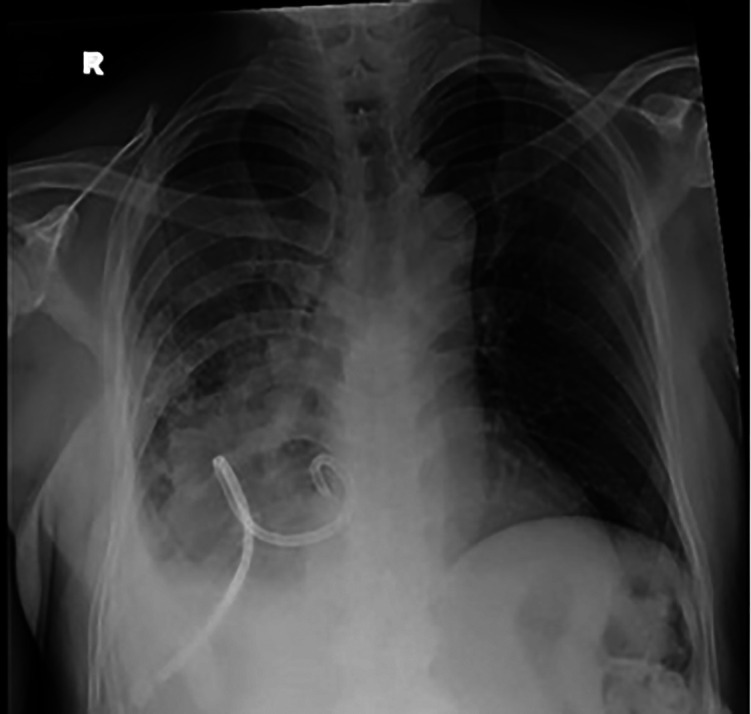 Granulomatosis with polyangiitis: The trigger cannot be long hidden.