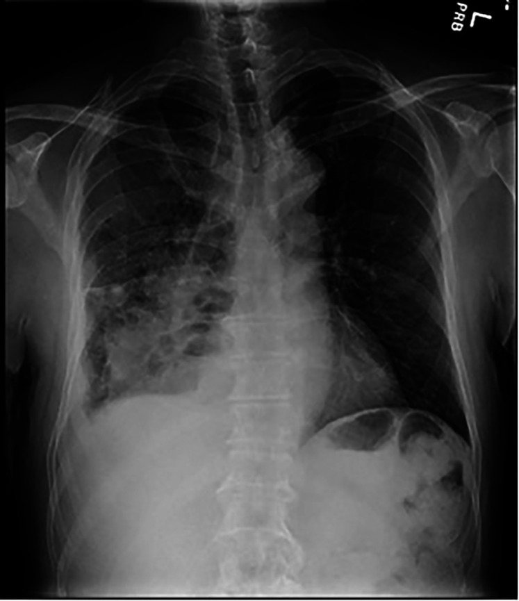 Granulomatosis with polyangiitis: The trigger cannot be long hidden.