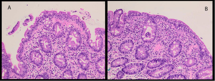 Challenging Results on FDG PET/CT in a Patient with Uncontrolled Celiac Disease and small bowel adenocarcinoma.